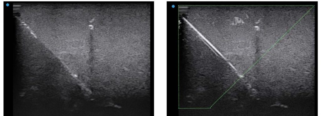 needle guidance on the Apogee