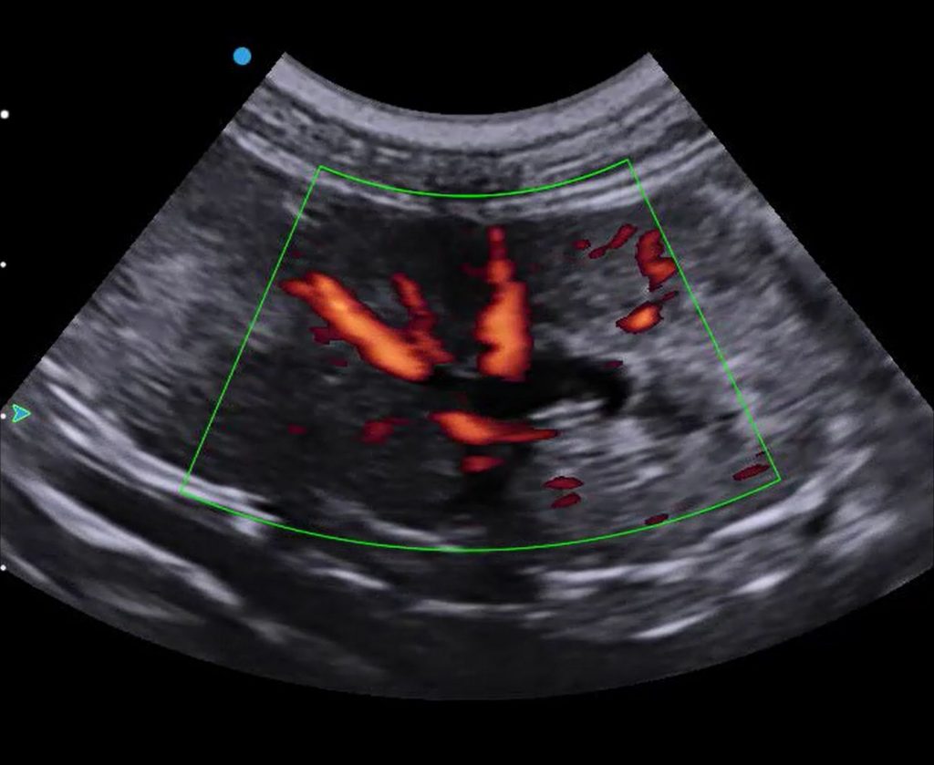 kidney thumbnail